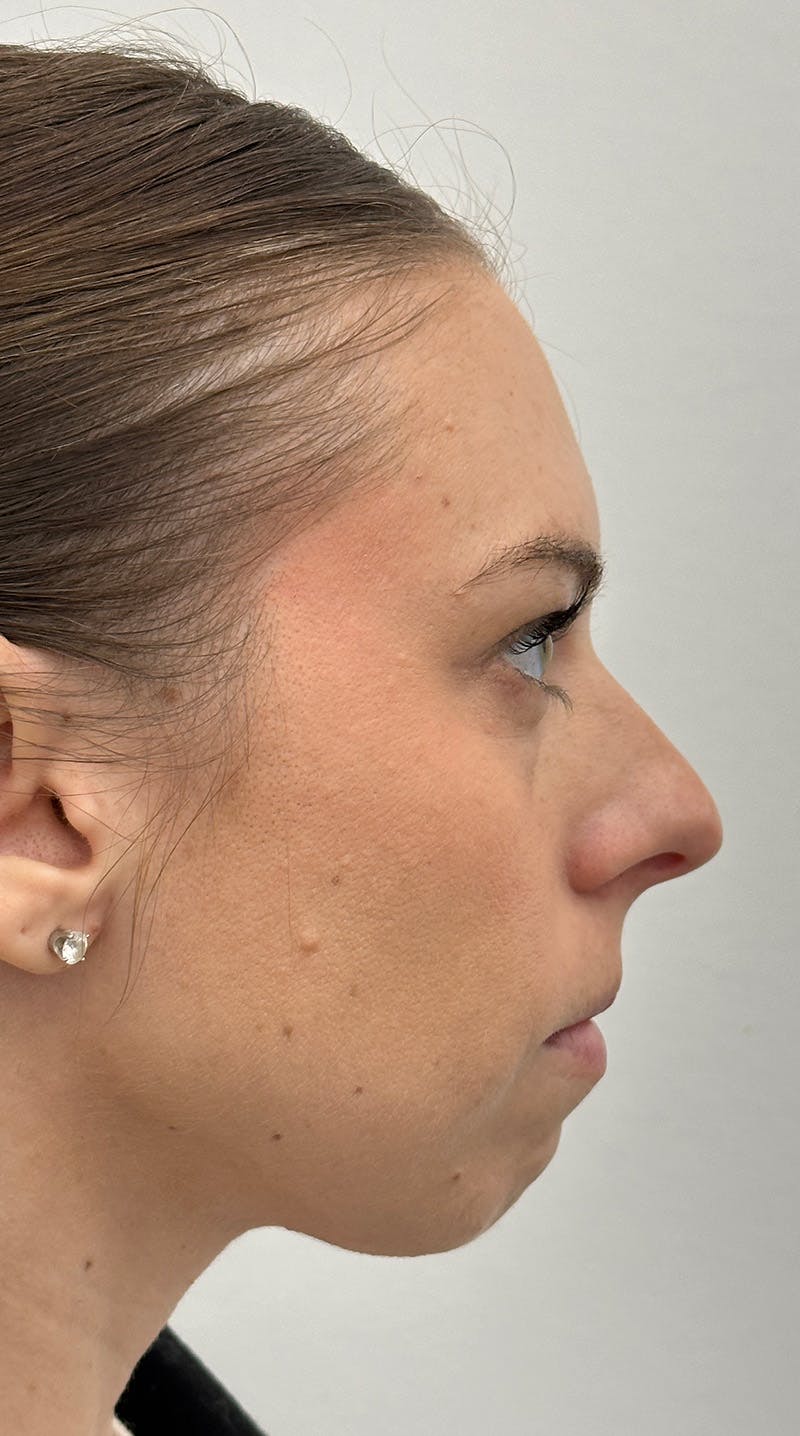 Rhinoplasty Before & After Gallery - Patient 386384 - Image 5