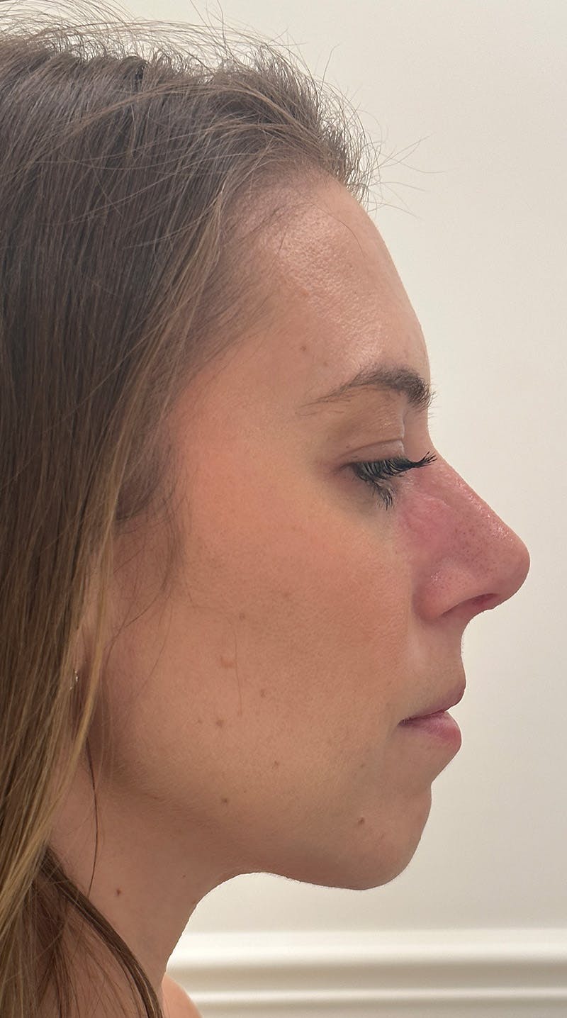 Rhinoplasty Before & After Gallery - Patient 386384 - Image 6