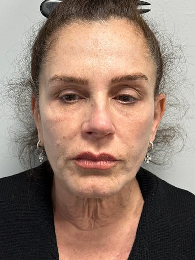 Facelift Before & After Gallery - Patient 123818 - Image 1