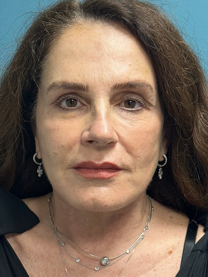 Facelift Before & After Gallery - Patient 123818 - Image 2