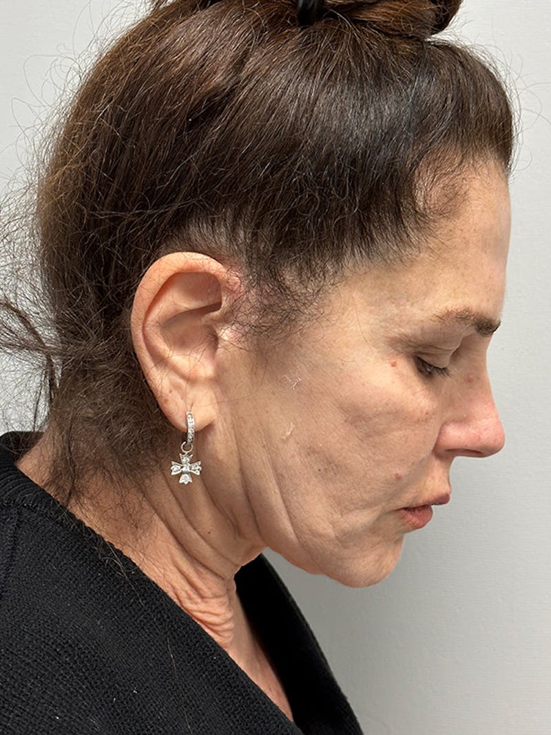 Facelift Before & After Gallery - Patient 123818 - Image 3