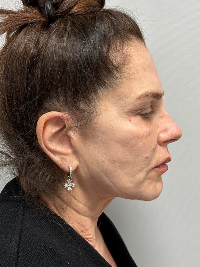 Facelift Before & After Gallery - Patient 123818 - Image 5