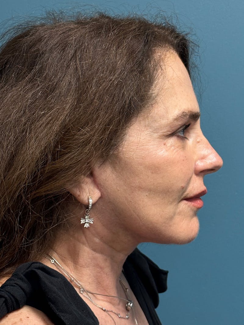 Facelift Before & After Gallery - Patient 123818 - Image 6
