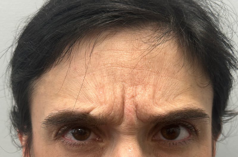BOTOX Before & After Gallery - Patient 184953 - Image 3