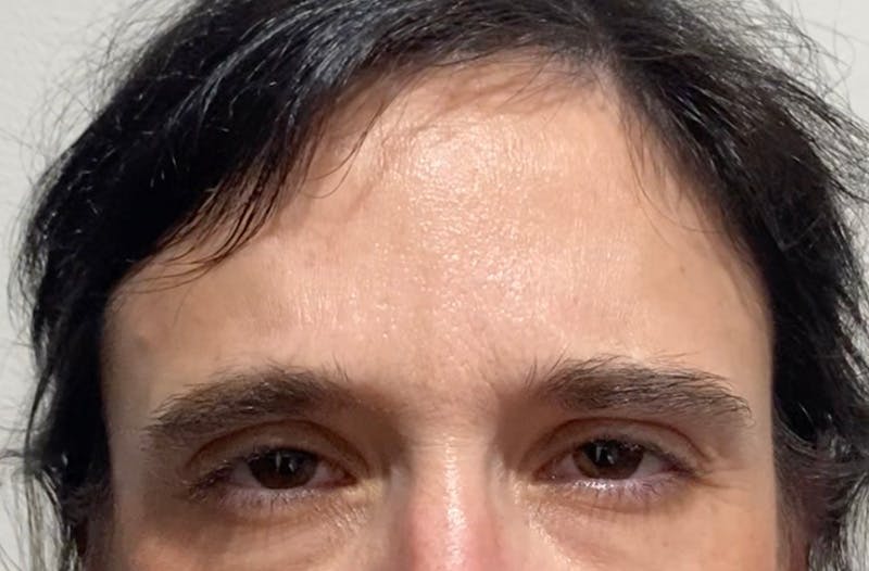 BOTOX Before & After Gallery - Patient 184953 - Image 4