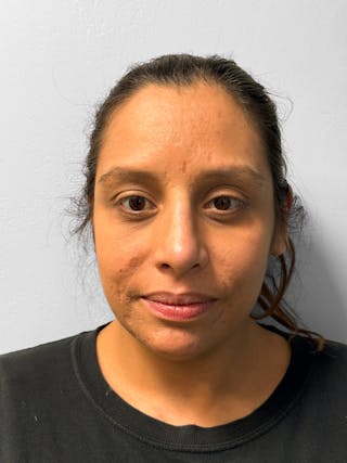 Rhinoplasty Before & After Gallery - Patient 157721 - Image 2