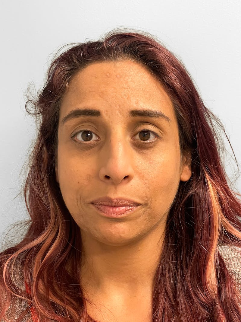 Rhinoplasty Before & After Gallery - Patient 157721 - Image 1