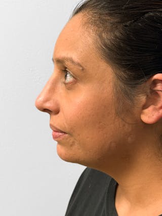 Rhinoplasty Before & After Gallery - Patient 157721 - Image 6