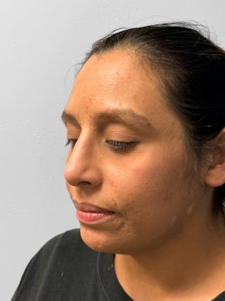 Rhinoplasty Before & After Gallery - Patient 157721 - Image 4