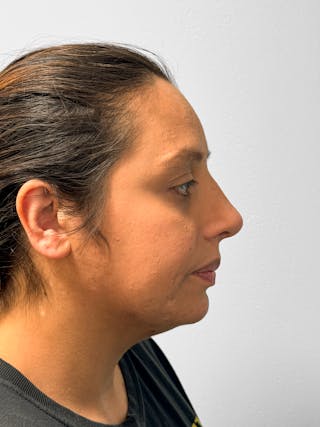 Rhinoplasty Before & After Gallery - Patient 157721 - Image 10