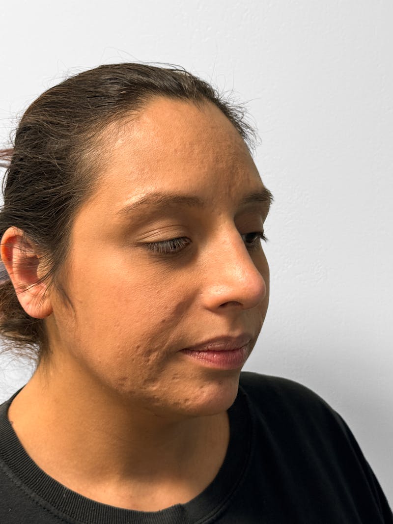 Rhinoplasty Before & After Gallery - Patient 157721 - Image 8