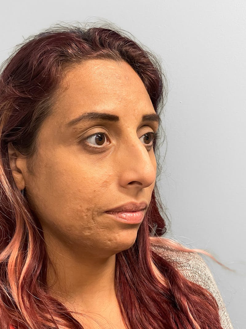 Rhinoplasty Before & After Gallery - Patient 157721 - Image 7