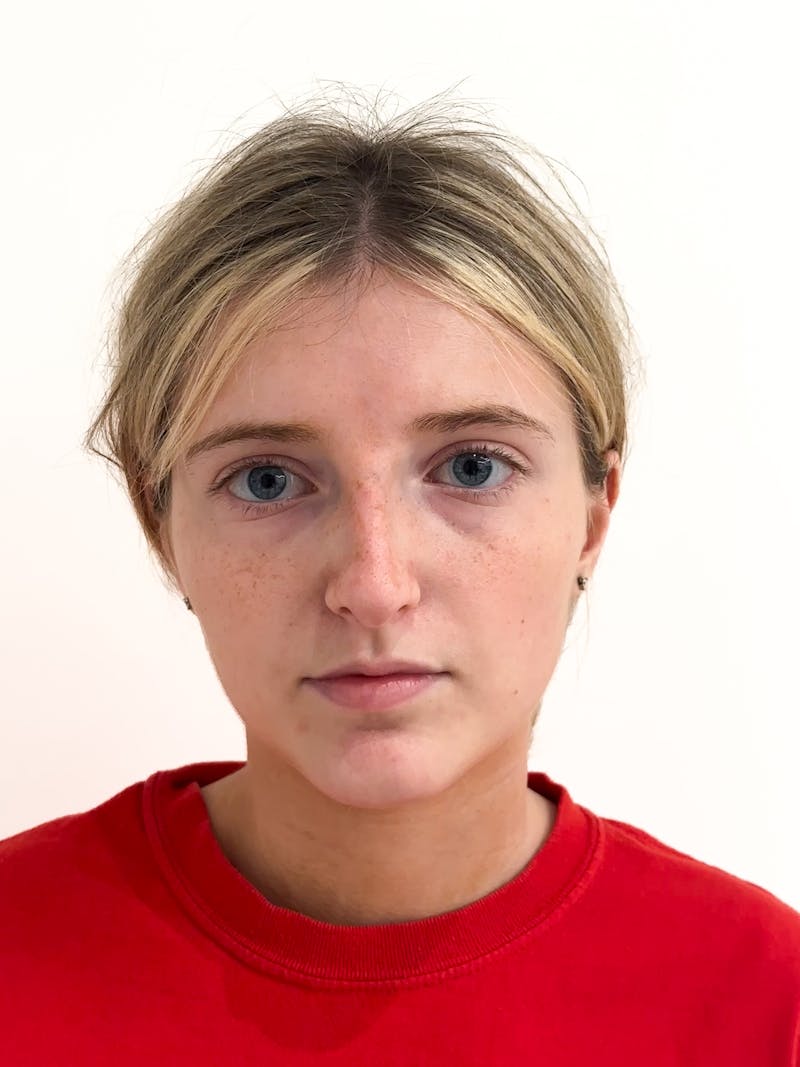 Rhinoplasty Before & After Gallery - Patient 396377 - Image 1