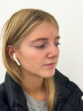 Rhinoplasty Before & After Gallery - Patient 396377 - Image 8