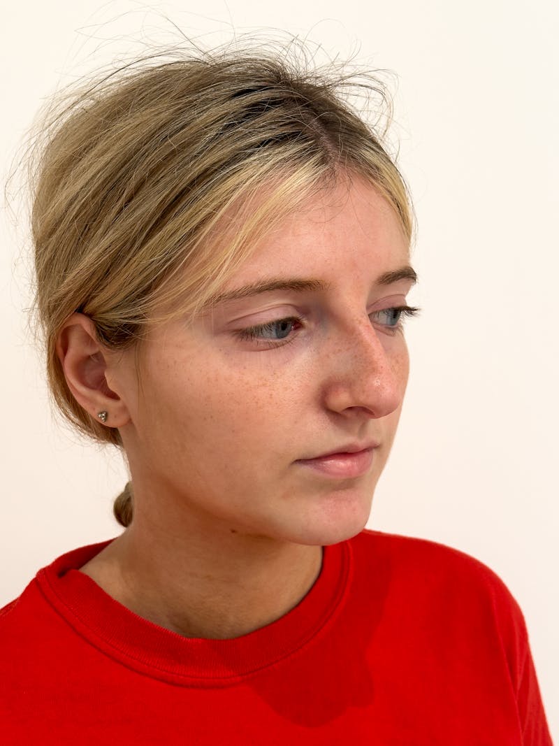 Rhinoplasty Before & After Gallery - Patient 396377 - Image 7