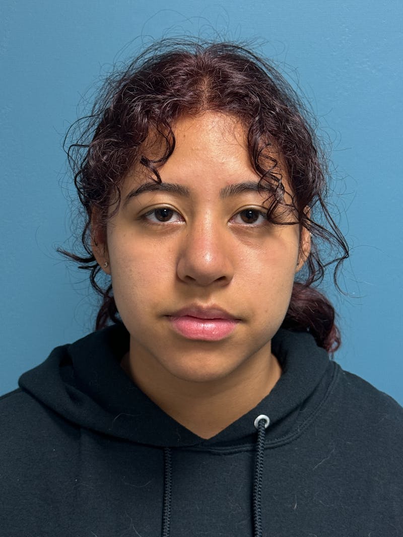 Rhinoplasty Before & After Gallery - Patient 282846 - Image 2