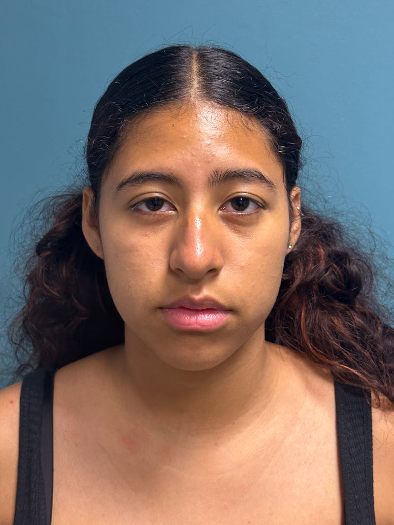 Rhinoplasty Before & After Gallery - Patient 282846 - Image 1