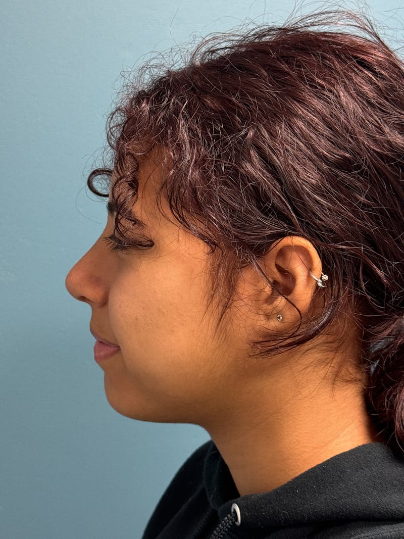 Rhinoplasty Before & After Gallery - Patient 282846 - Image 6