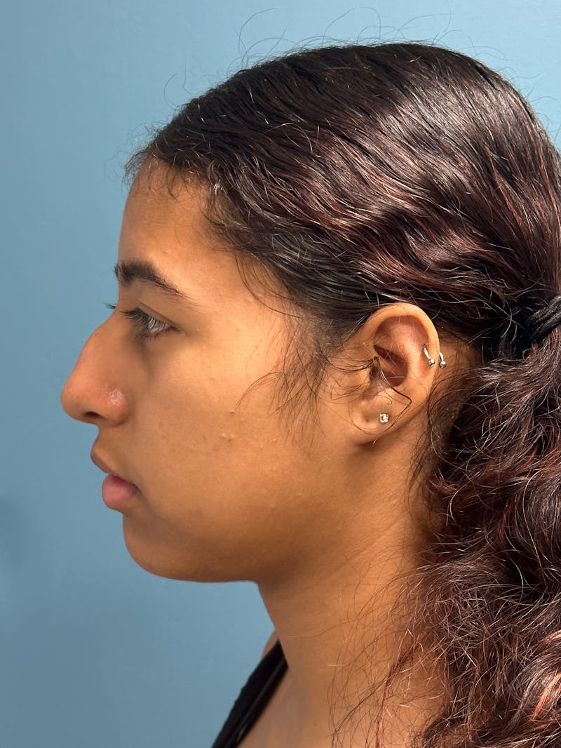 Rhinoplasty Before & After Gallery - Patient 282846 - Image 5