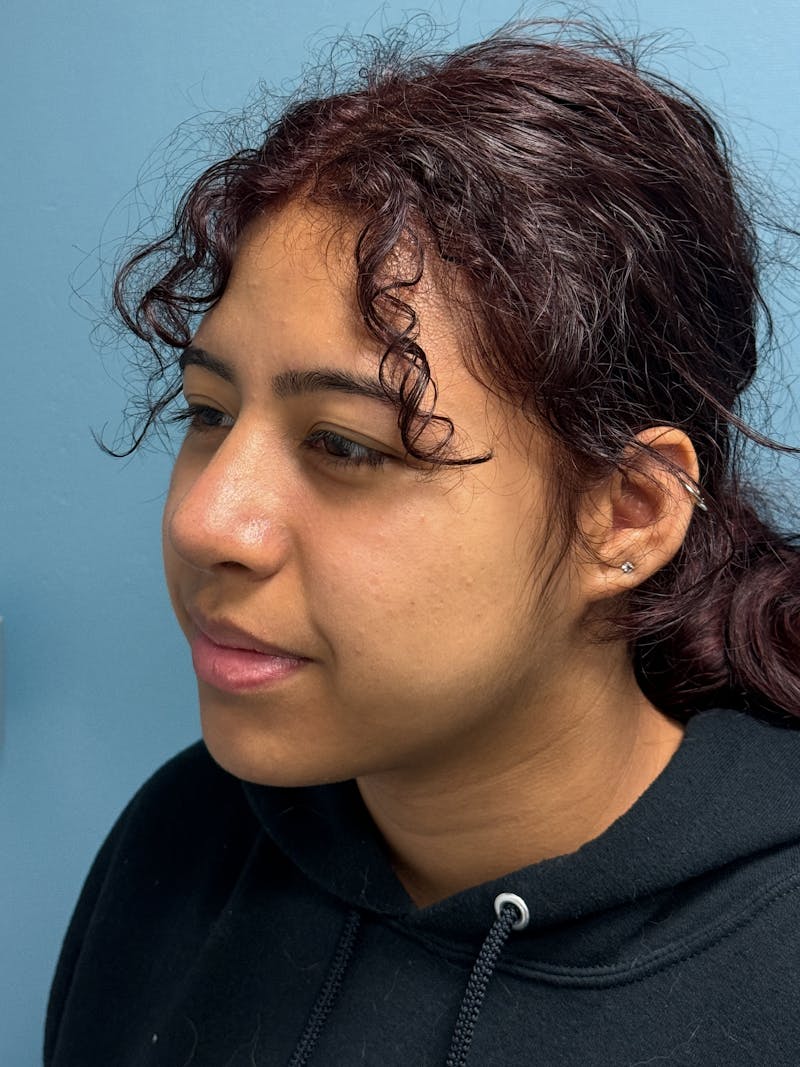 Rhinoplasty Before & After Gallery - Patient 282846 - Image 4