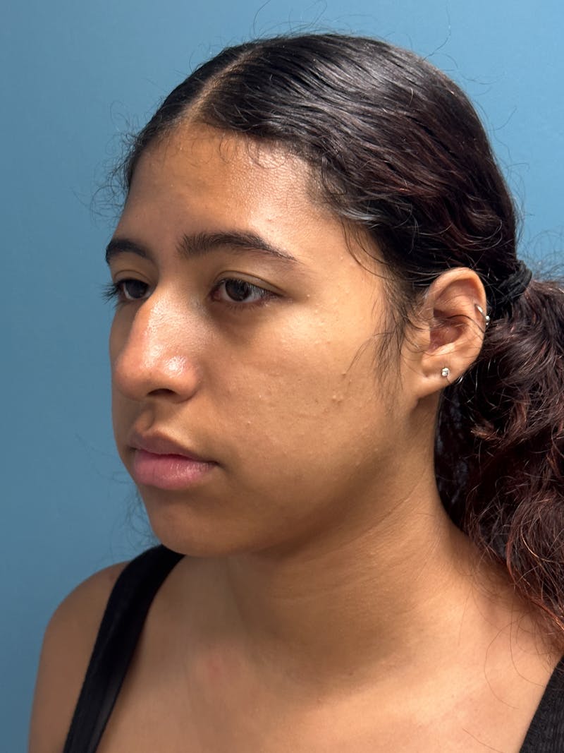 Rhinoplasty Before & After Gallery - Patient 282846 - Image 3