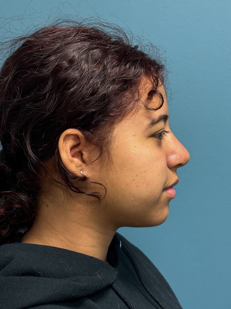 Rhinoplasty Before & After Gallery - Patient 282846 - Image 10