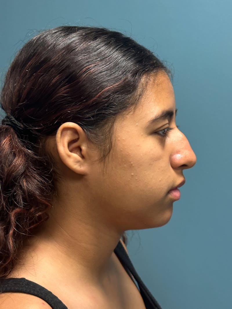Rhinoplasty Before & After Gallery - Patient 282846 - Image 9
