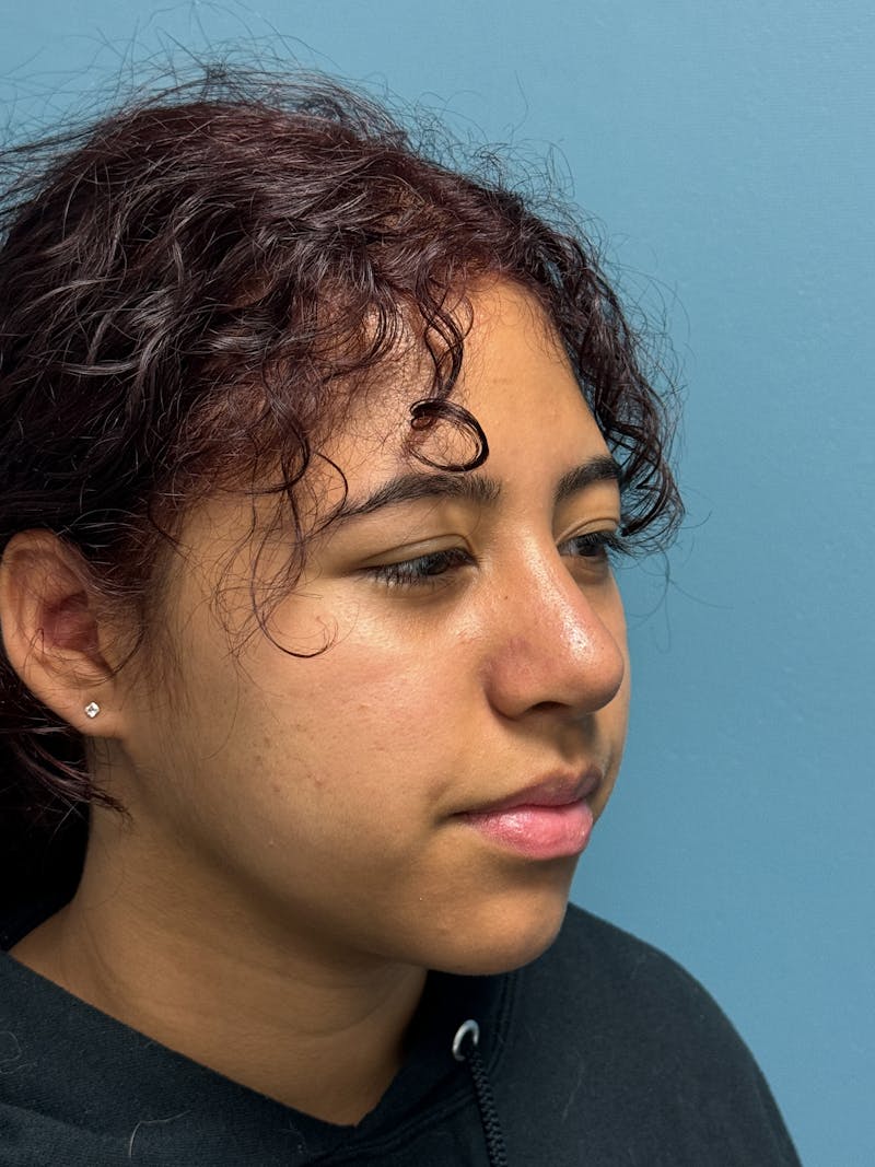 Rhinoplasty Before & After Gallery - Patient 282846 - Image 8