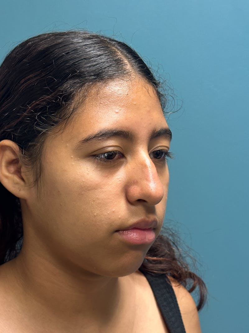 Rhinoplasty Before & After Gallery - Patient 282846 - Image 7