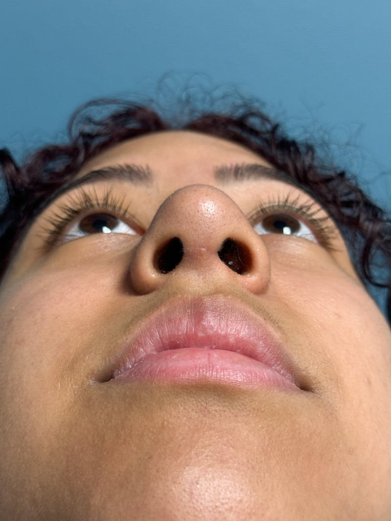 Rhinoplasty Before & After Gallery - Patient 282846 - Image 12