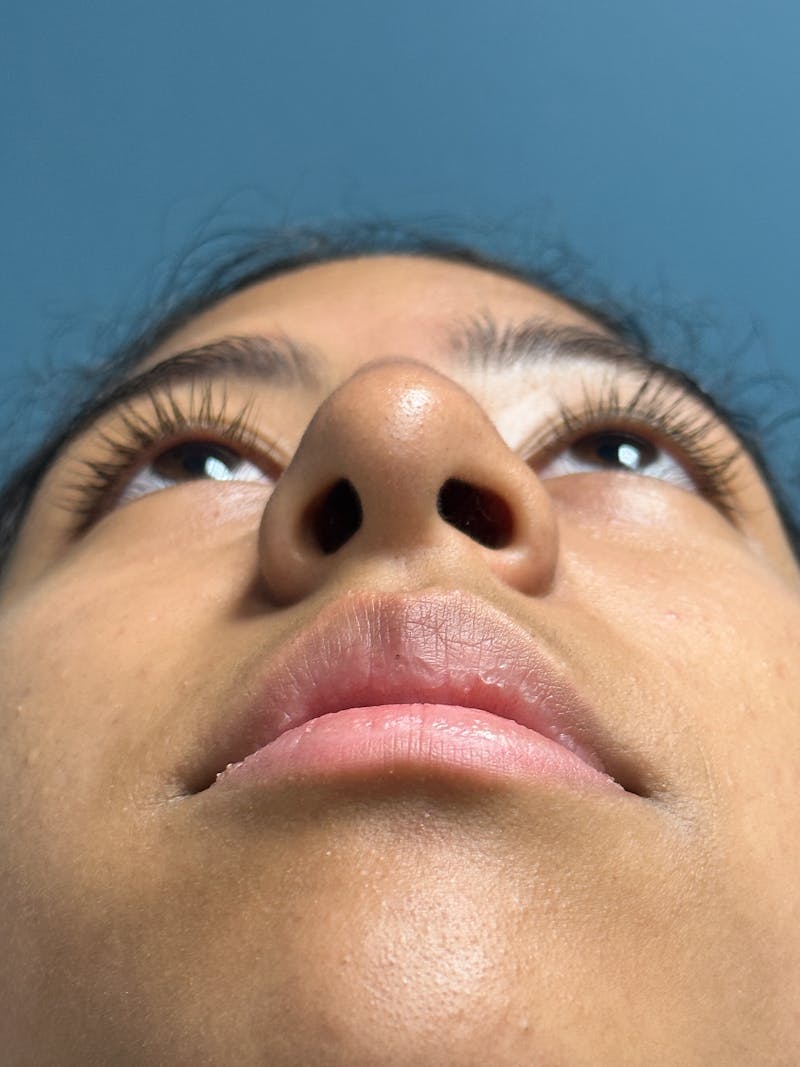 Rhinoplasty Before & After Gallery - Patient 282846 - Image 11