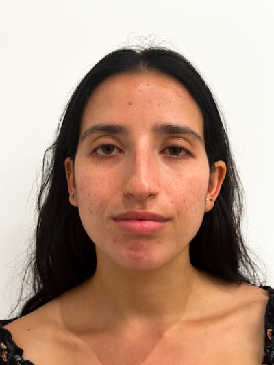 Rhinoplasty Before & After Gallery - Patient 214398 - Image 1