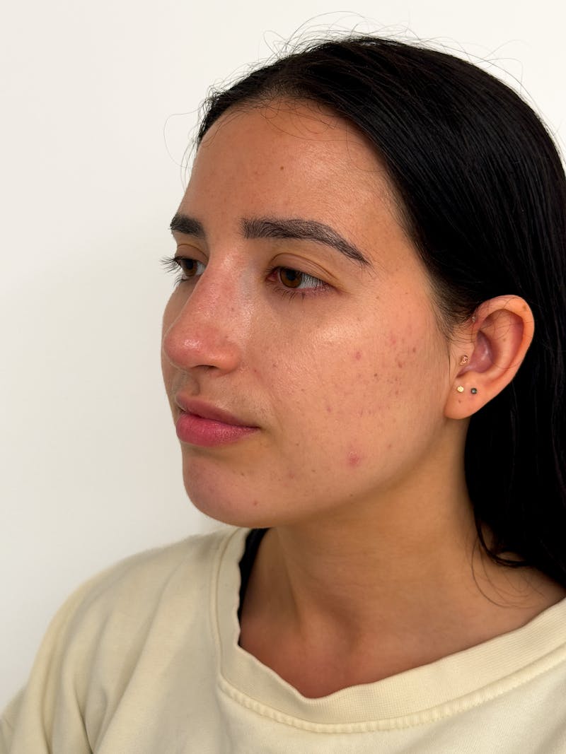 Rhinoplasty Before & After Gallery - Patient 214398 - Image 8