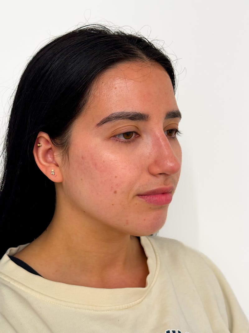 Rhinoplasty Before & After Gallery - Patient 214398 - Image 4
