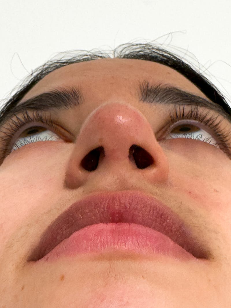 Rhinoplasty Before & After Gallery - Patient 214398 - Image 12