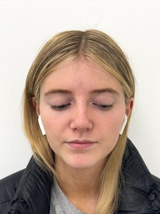Rhinoplasty Before & After Gallery - Patient 396377 - Image 2