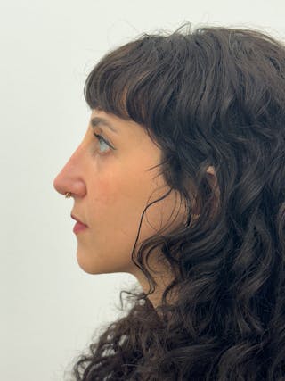 Rhinoplasty Before & After Gallery - Patient 181587 - Image 6