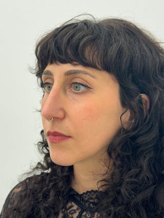 Rhinoplasty Before & After Gallery - Patient 181587 - Image 4