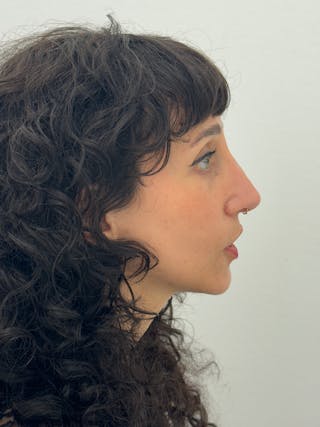 Rhinoplasty Before & After Gallery - Patient 181587 - Image 10