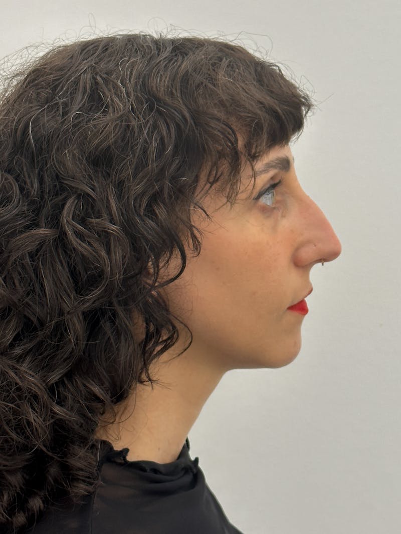 Rhinoplasty Before & After Gallery - Patient 181587 - Image 9
