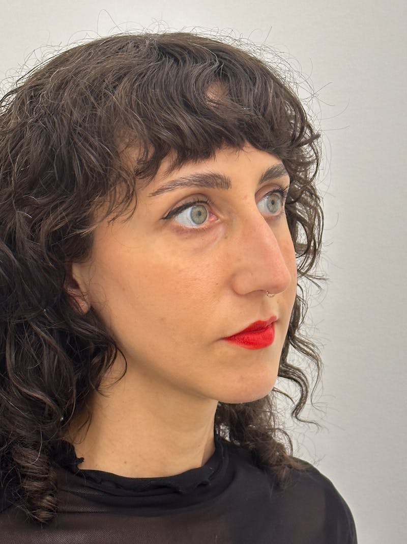 Rhinoplasty Before & After Gallery - Patient 181587 - Image 7