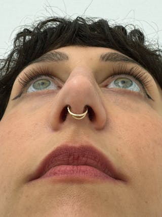 Rhinoplasty Before & After Gallery - Patient 181587 - Image 12