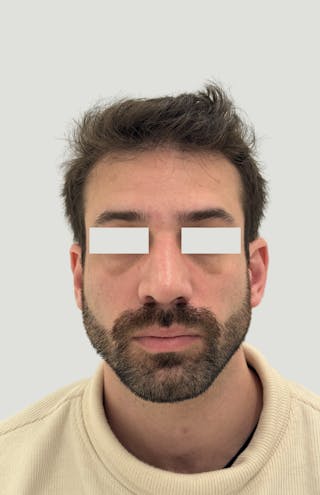 Rhinoplasty Before & After Gallery - Patient 357661 - Image 2
