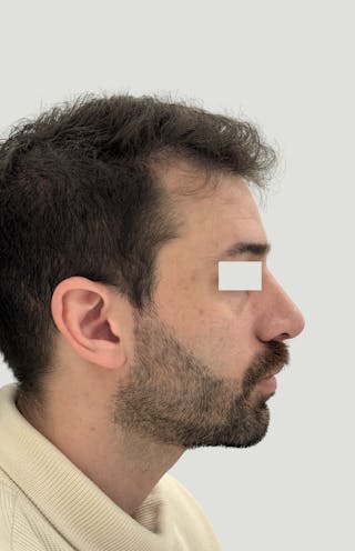 Rhinoplasty Before & After Gallery - Patient 357661 - Image 6