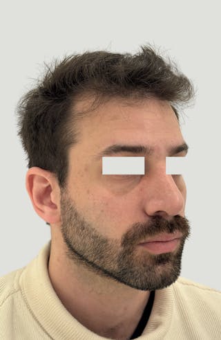 Rhinoplasty Before & After Gallery - Patient 357661 - Image 4