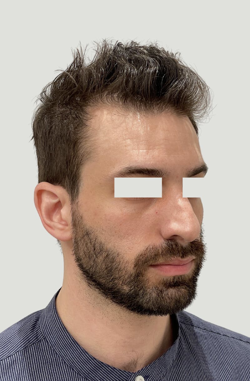Rhinoplasty Before & After Gallery - Patient 357661 - Image 3