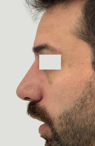 Rhinoplasty Before & After Gallery - Patient 357661 - Image 8