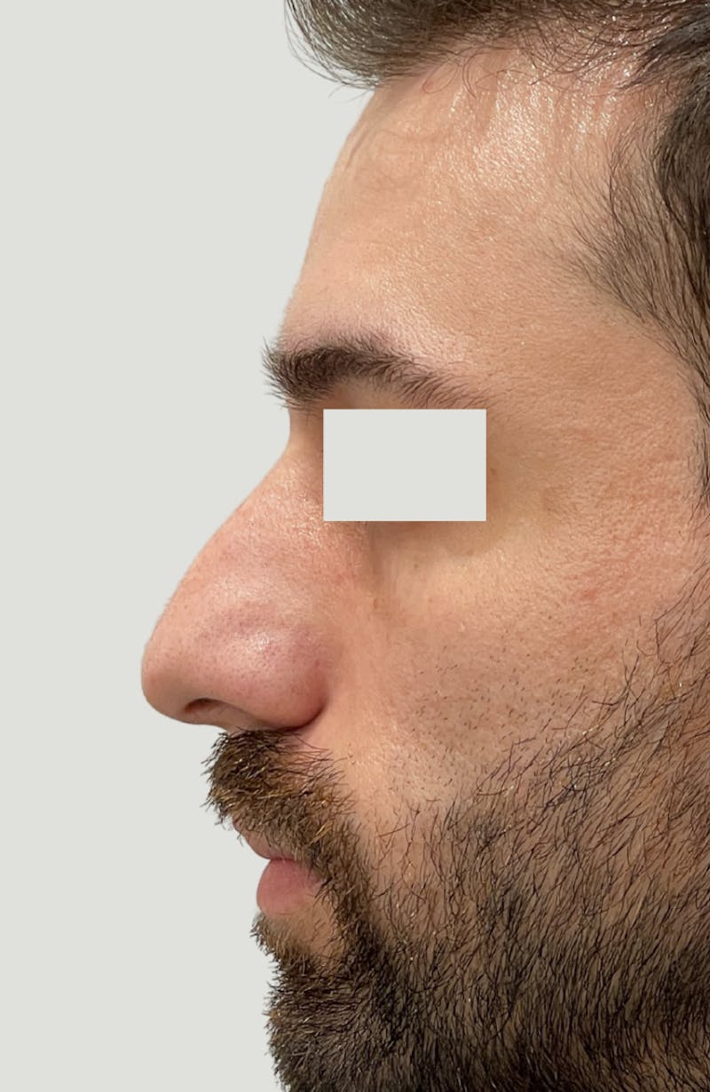 Rhinoplasty Before & After Gallery - Patient 357661 - Image 7