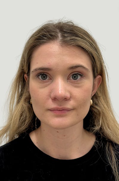 Rhinoplasty Before & After Gallery - Patient 104016 - Image 2