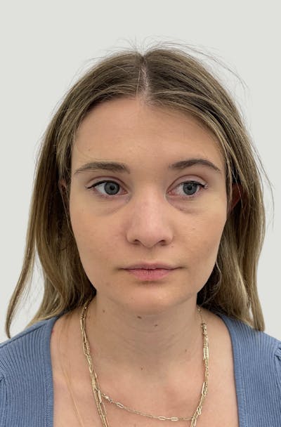 Rhinoplasty Before & After Gallery - Patient 104016 - Image 1